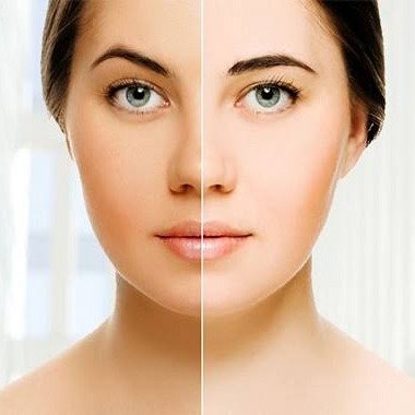 Skin Whitening Facial