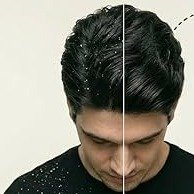 Anti-Dandruff Treatment